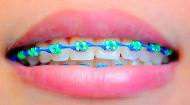 10 Cara Merawat Gigi Berbehel Dengan Tepat Dan Benar